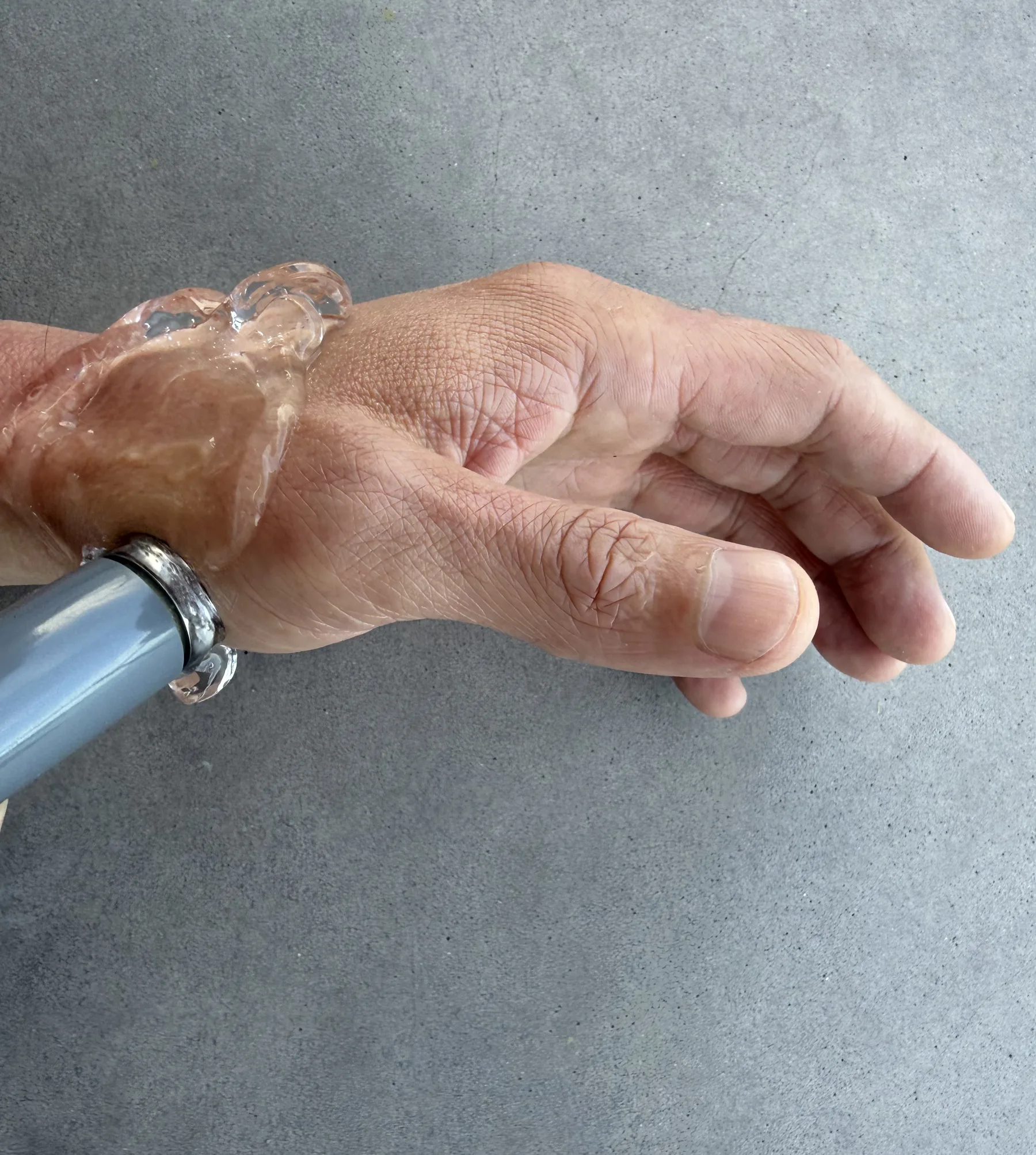 Therapeutic ultrasound modality — gel and wand on wrist