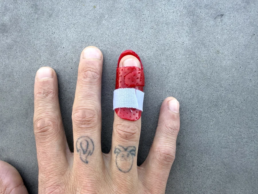 Custom splint — red orthotic on finger